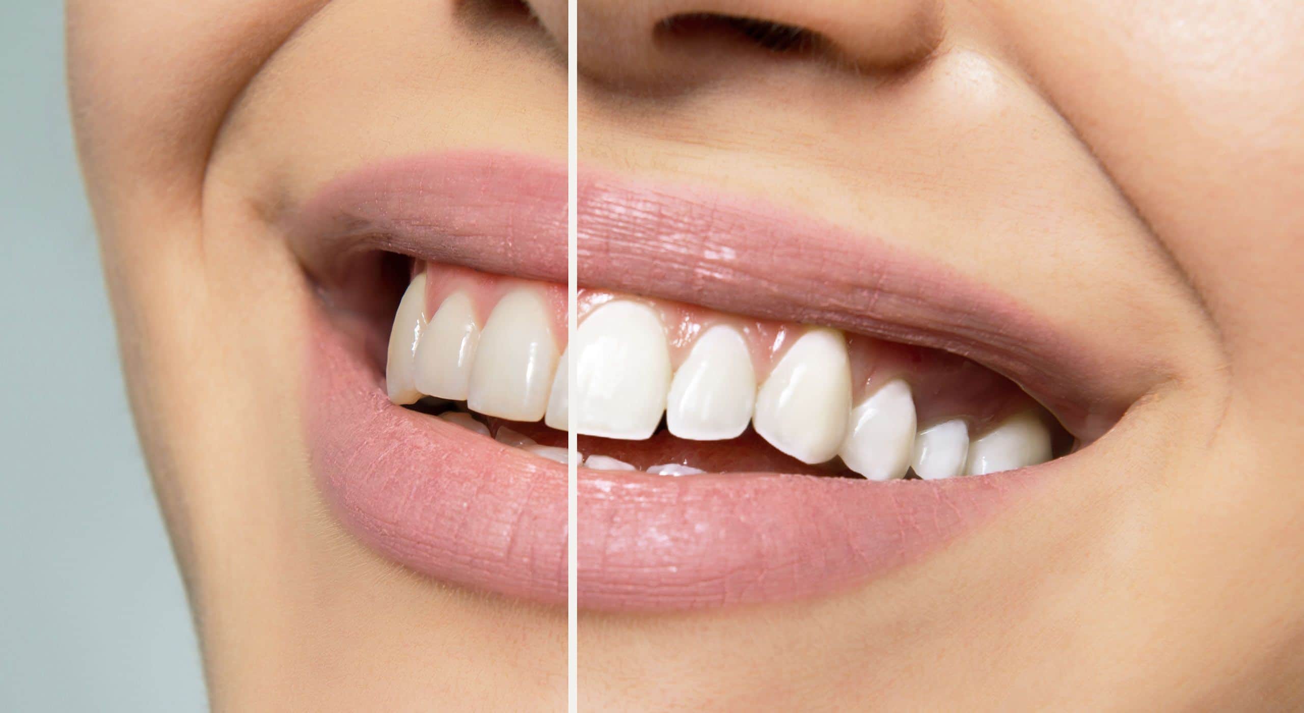 Illustration : sourire avant et après un blanchiment dentaire cosmétique